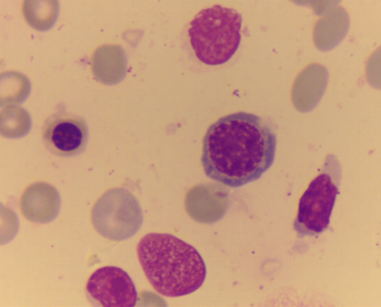 中幼、晚幼红细胞对比图.bmp